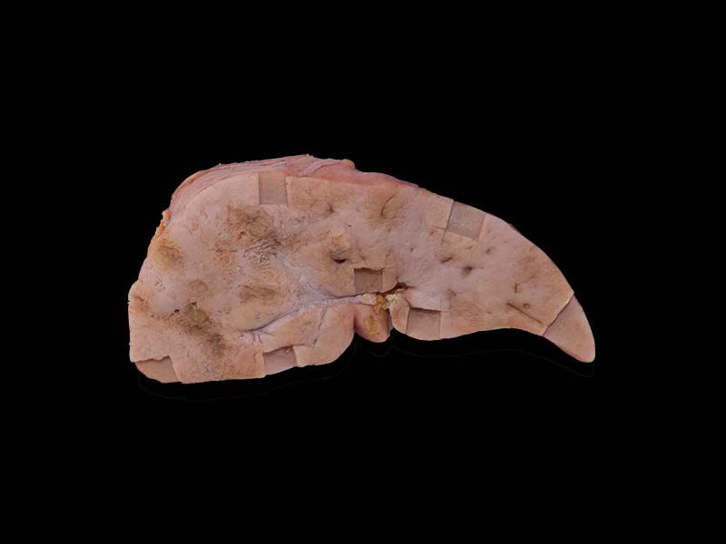 Soft SiliconeHepatic Vascular Endothelial Cell Sarcoma Model