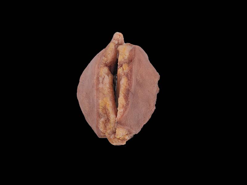 Soft Simulated Breast Cancer Anatomy Model
