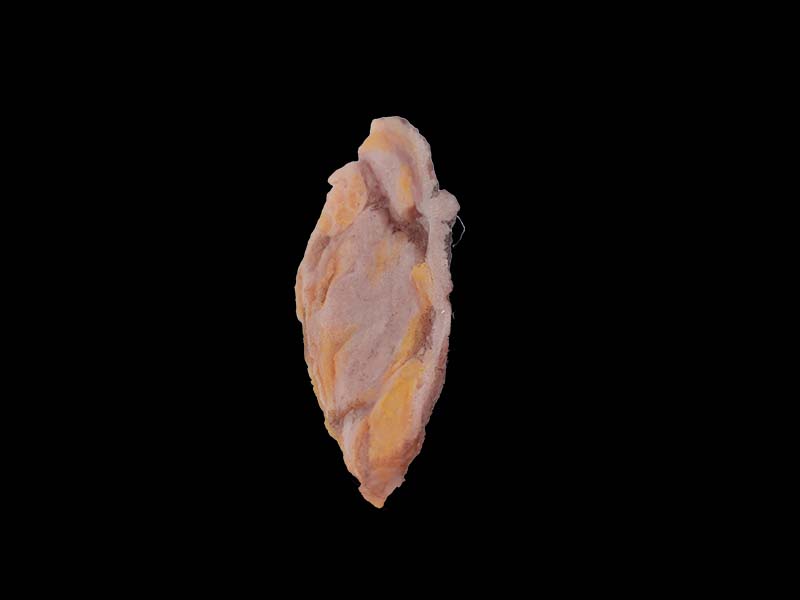 Soft Simulated Breast Cancer Model
