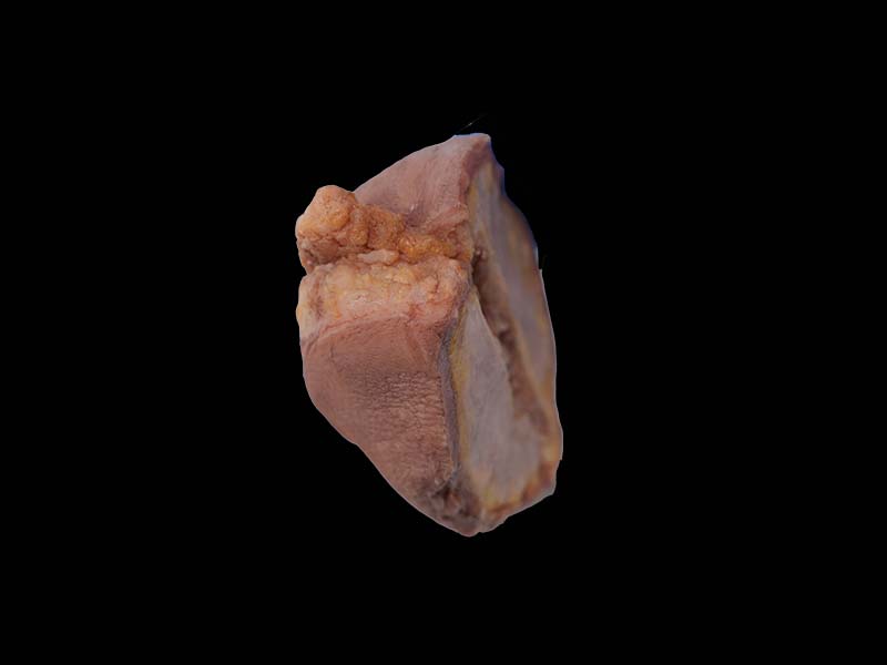 Soft Simulated Breast Cancer Model