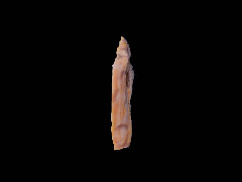 Soft Simulated Breast Cancer Silicone Anatomy Model