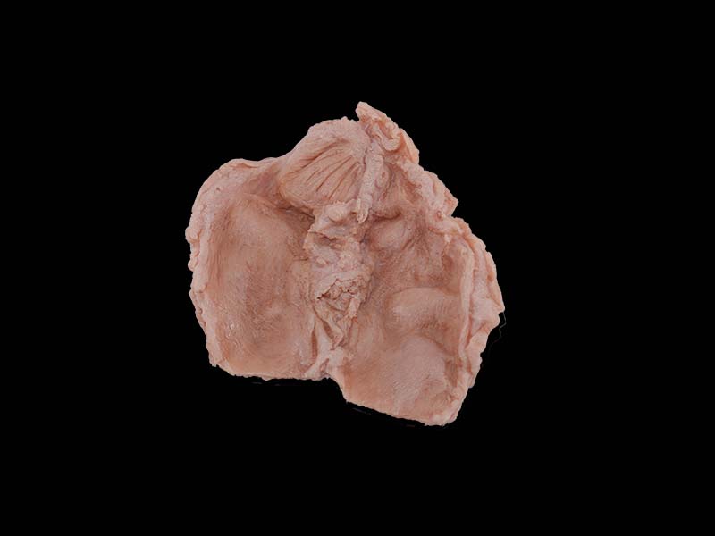 Soft Simulated Duodenal Ulcer Model