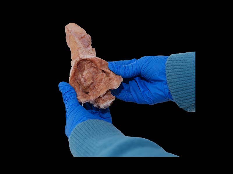 Soft Simulated Esophageal Cancer Model