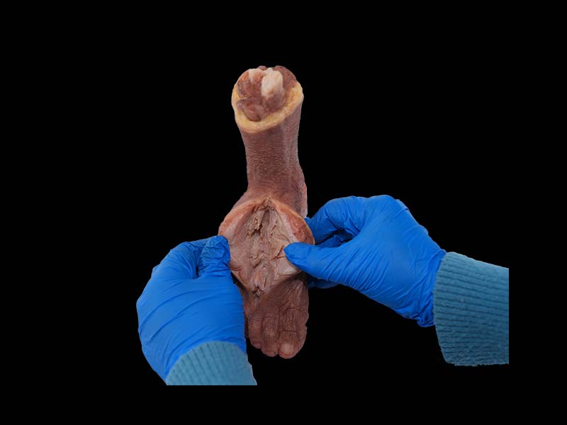 Soft Simulated Malignant Hemangioendothelioma of Dorsal Foot Anatomy Model
