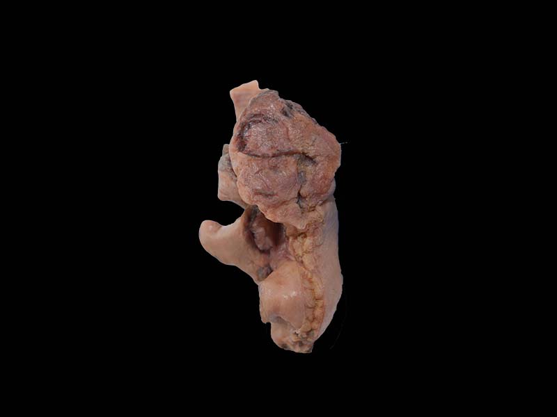 Soft Simulated Malignant Pleural Mesothelioma Anatomy Model