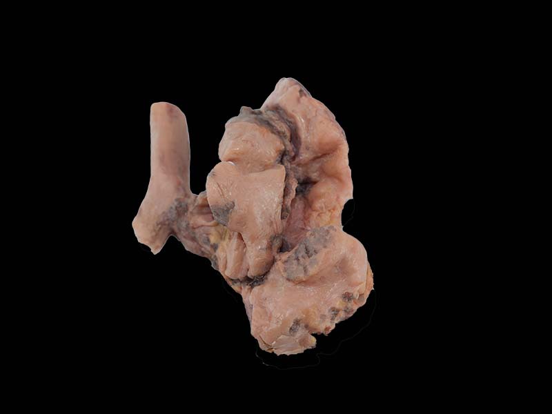 Soft Simulated Malignant Pleural Mesothelioma Model