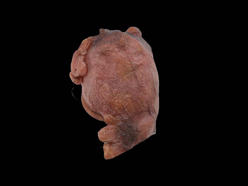 Soft Simulated Multiple Uterine Fibroids Anatomy Model