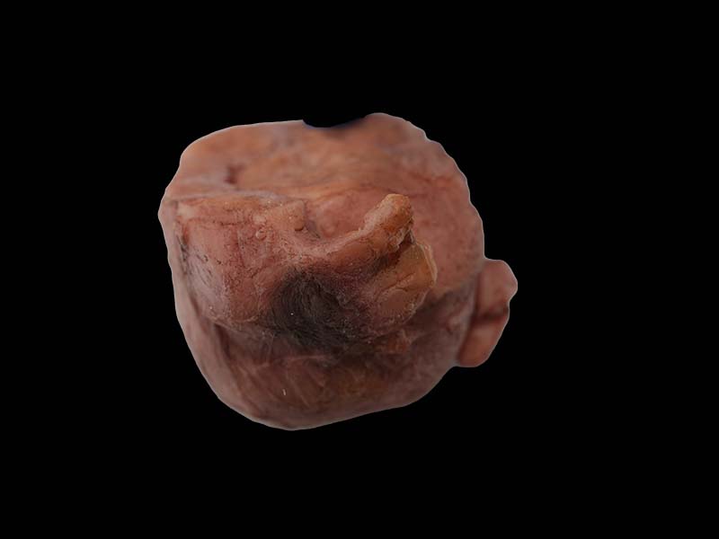 Soft Simulated Multiple Uterine Fibroids Model
