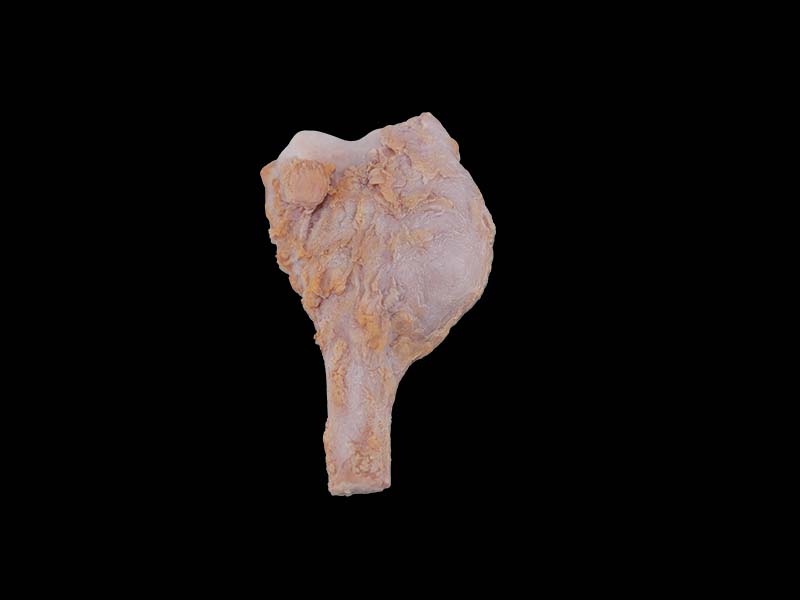 Soft Simulated Osteosarcoma Anatomy Model