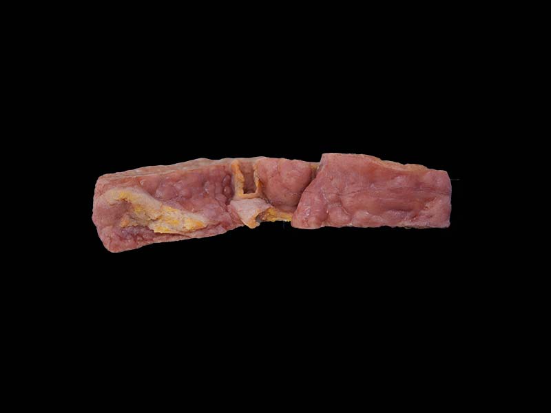 Soft Simulated Portal Cirrhosis Complicated with Cell Carcinoma Model