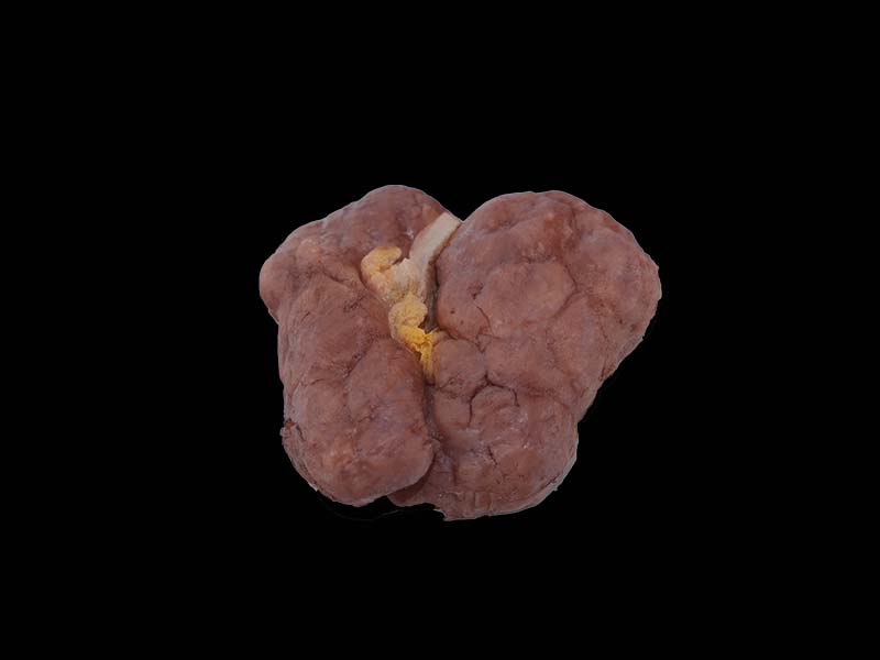 Soft Simulated Renal Tuberculosis Model