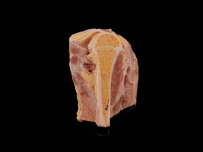 Soft Simulated Tuberculosis of Knee Joint Model