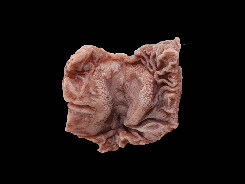 Soft Simulated Ulcerative Gastric Cancer Anatomy Model