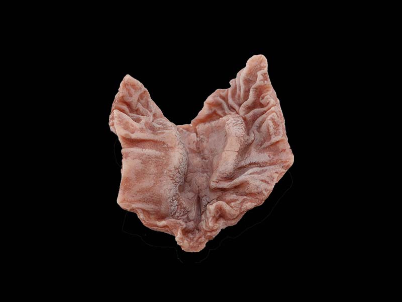 Soft Simulated Ulcerative Gastric Cancer Model