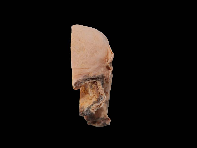 Soft Simulated Uterine Gangrene Anatomy Model