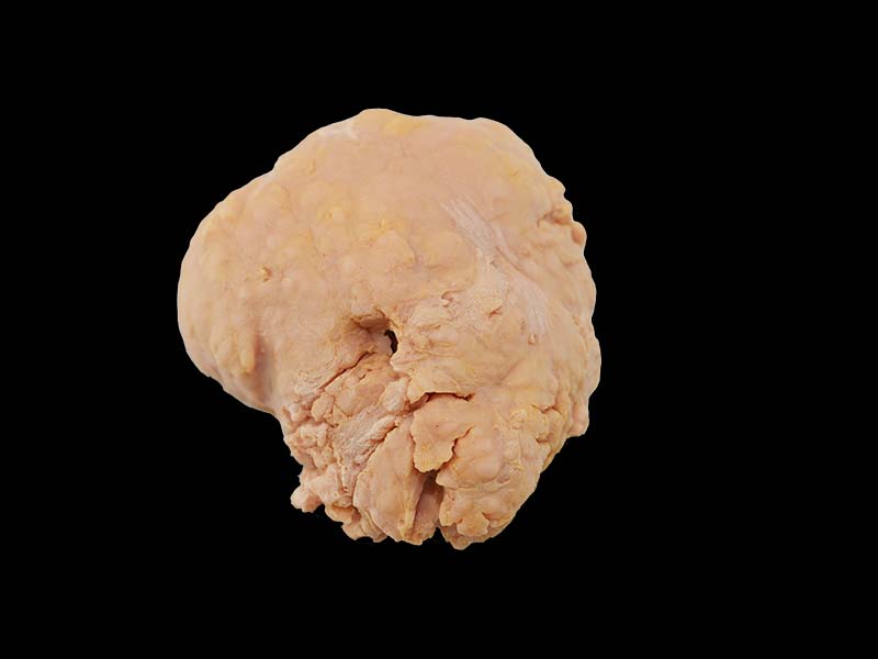 Soft Simulated Uterine Leiomyoma Anatomy Model