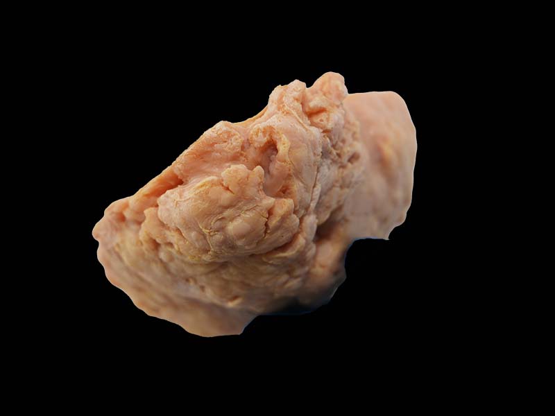 Soft Simulated Uterine Leiomyoma Model