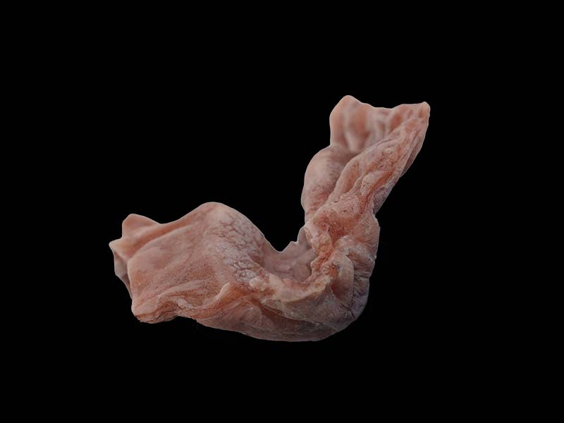 Soft Slicone Ulcerative Gastric Cancer Model