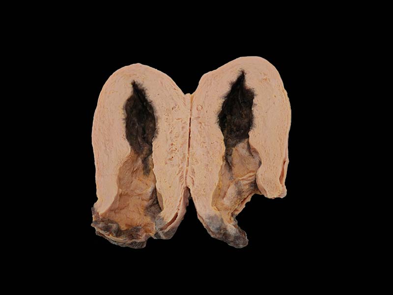 Soft Uterine Gangrene Model