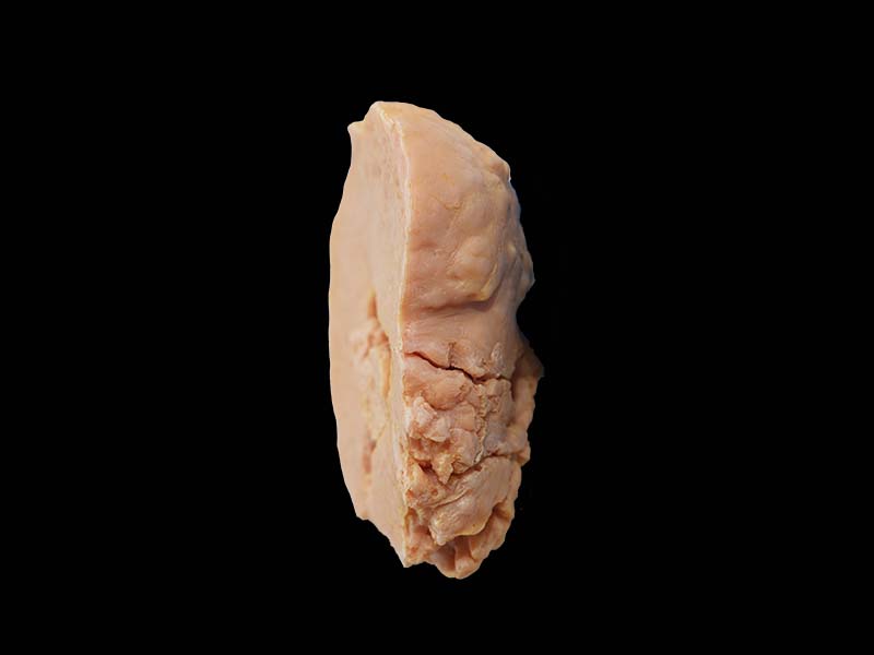 Soft Uterine Leiomyoma Model