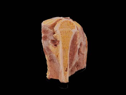Tuberculosis of Knee Joint Model