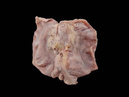 Ulcerative Gastric Cancer Model